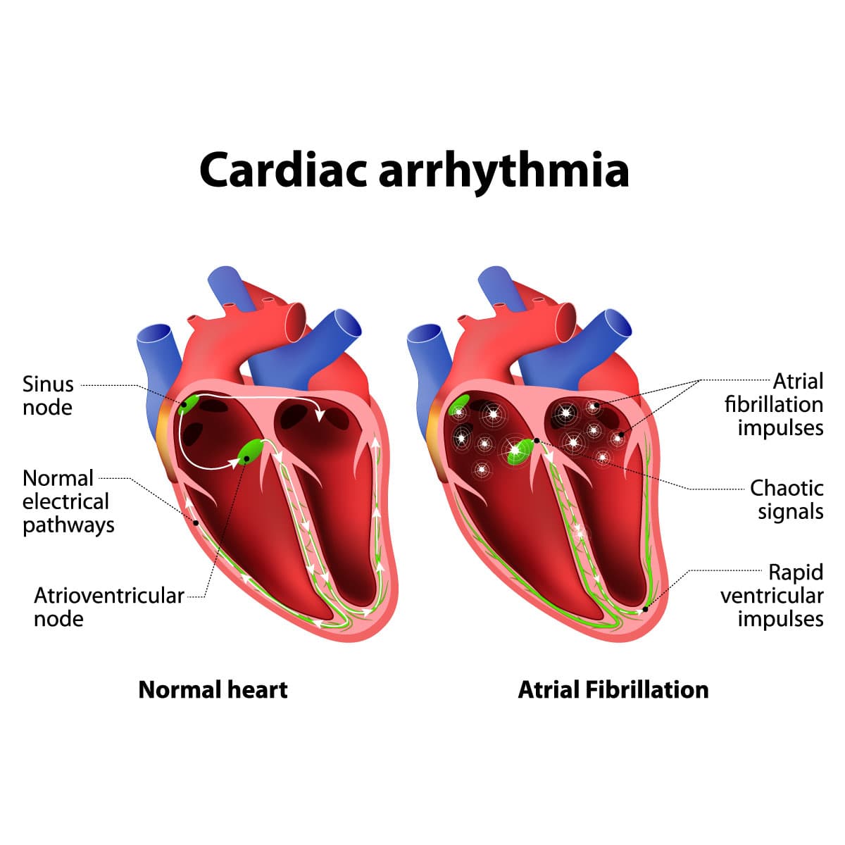 Arrhythmias medical condition