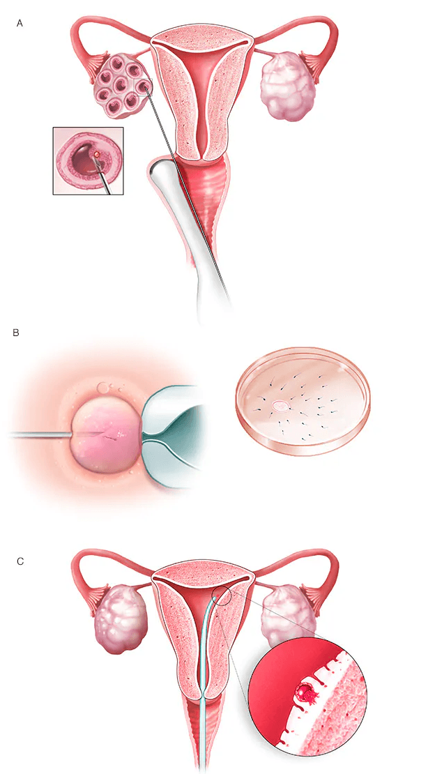 In-vitro-Fertilization (IVF) medical condition