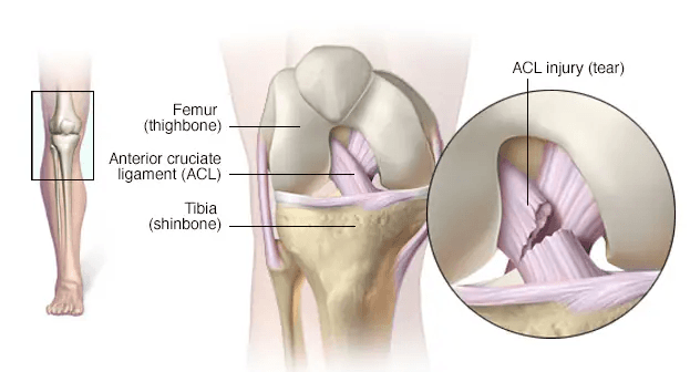 Anterior Cruciate Ligament (ACL) Injury medical condition