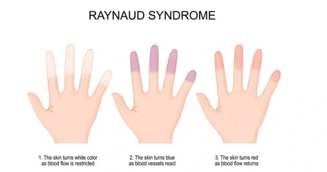 Raynaud's syndrome medical condition