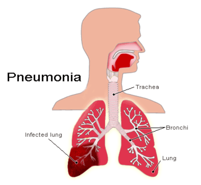 Occupational Lung Diseases medical condition