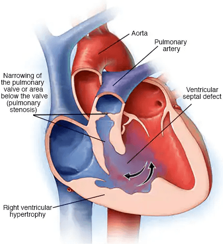 Tetralogy of Fallot (ToF) medical condition