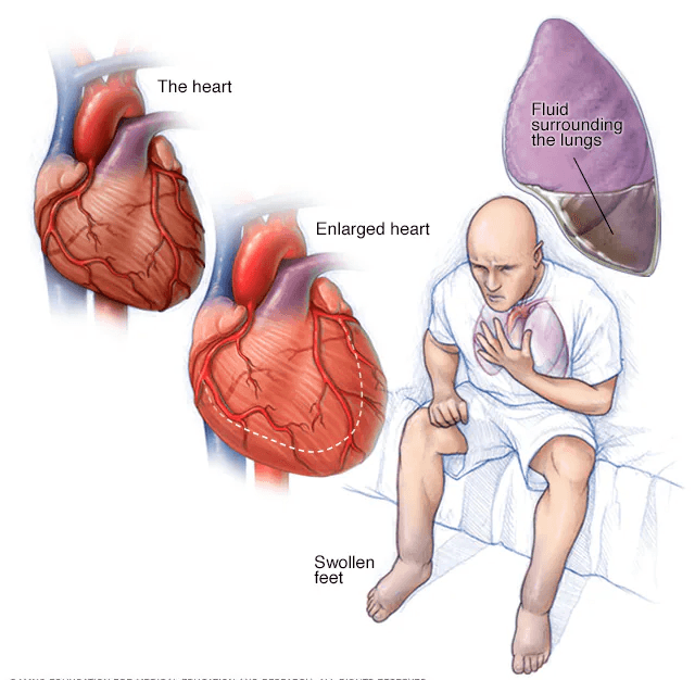 Heart Failure medical condition
