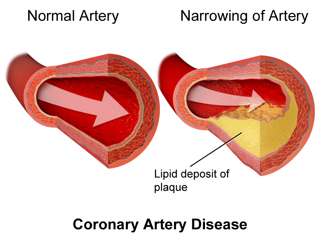 Coronary Artery Disease (CAD) medical condition