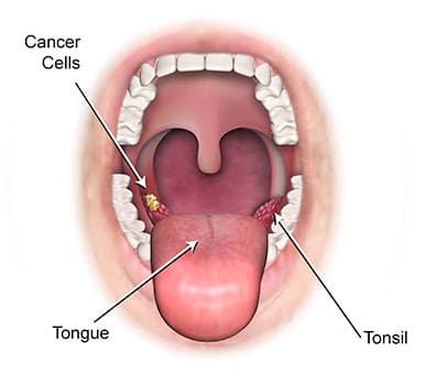 Tongue Cancer medical condition