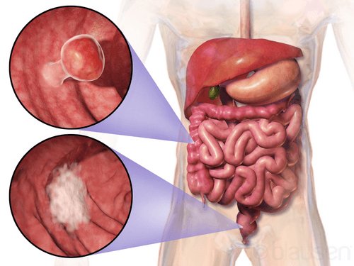 Colon and Rectum Cancer (Colorectal Cancer) medical condition