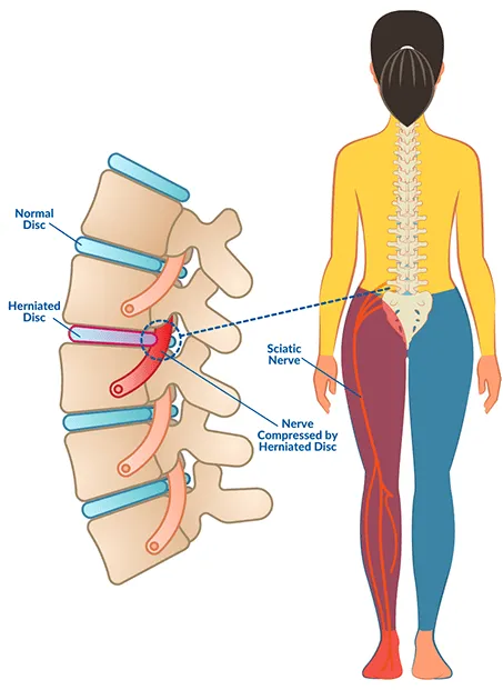 Herniated Discs medical condition