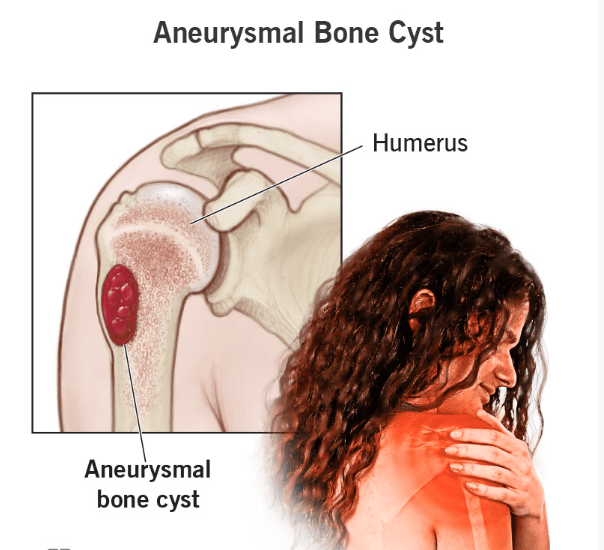 Bone Cysts medical condition