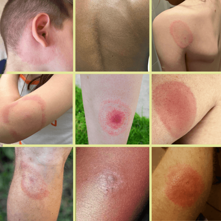 Lyme Disease medical condition