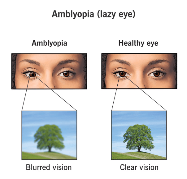 Amblyopia medical condition