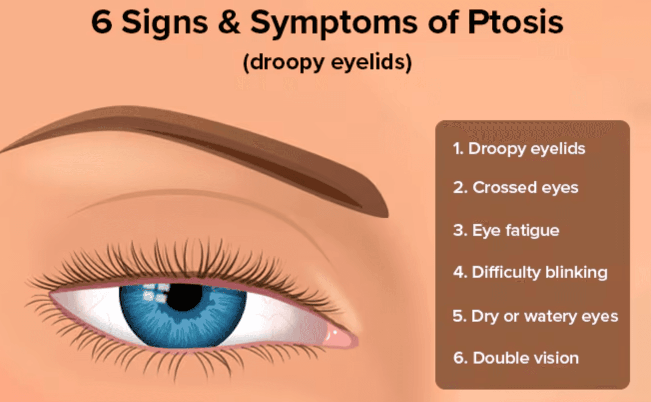 Ptosis (Droopy Eyelid) medical condition
