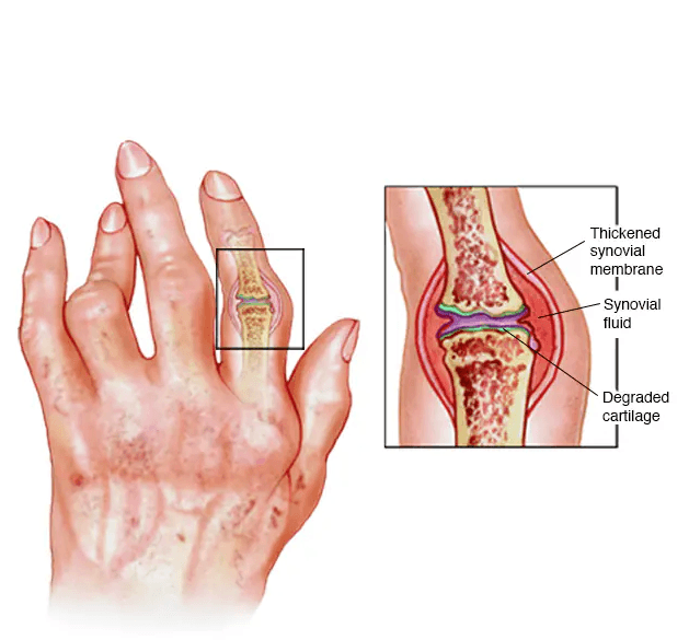 Rheumatoid arthritis medical condition