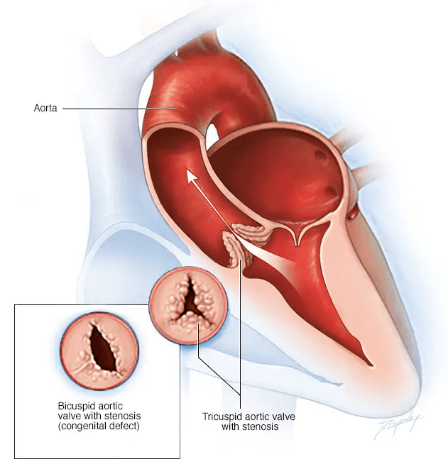 Aortic Valve Stenosis medical condition