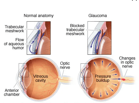 Glaucoma medical condition