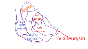 Left Ventricular Aneurysm medical condition