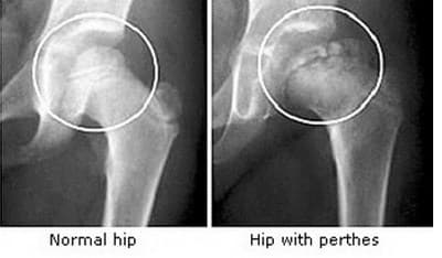 Perthes Disease medical condition