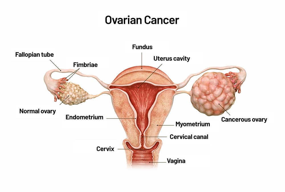 Ovarian Cancer medical condition