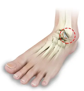 Ankle arthritis medical condition