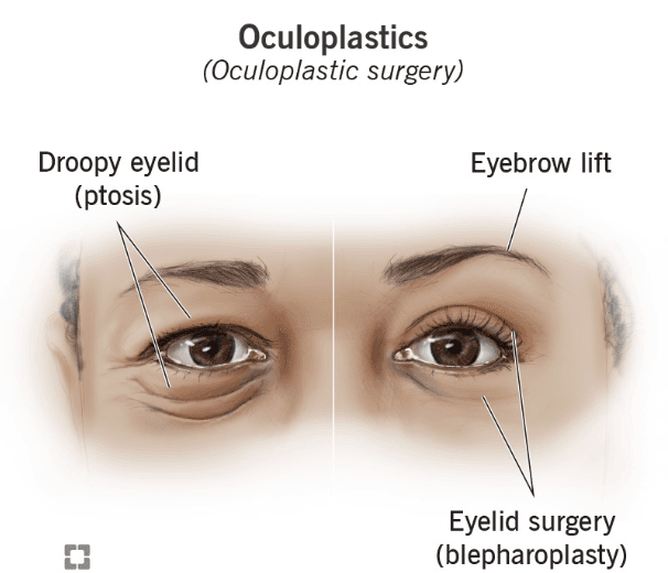 Oculoplastic surgery medical condition