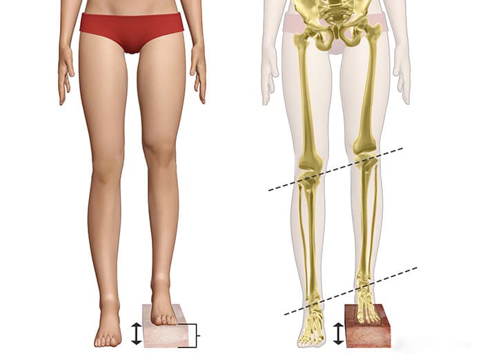 Limb Length Discrepancy medical condition