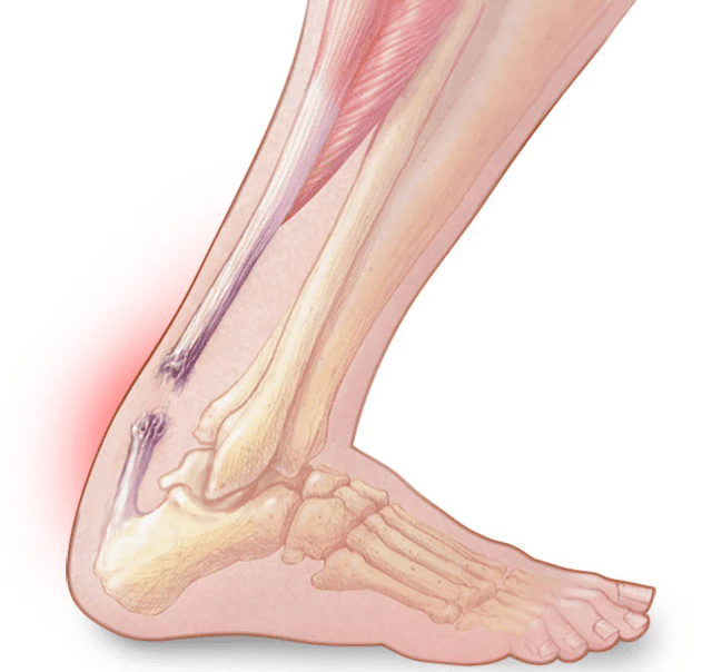 Achilles Tendon Rupture medical condition