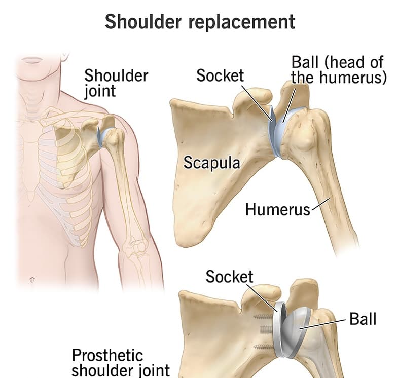 Shoulder Joint Replacement medical condition