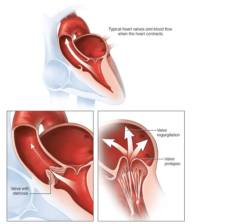 Valve Diseases medical condition