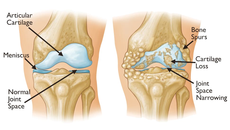 Osteoarthritis medical condition