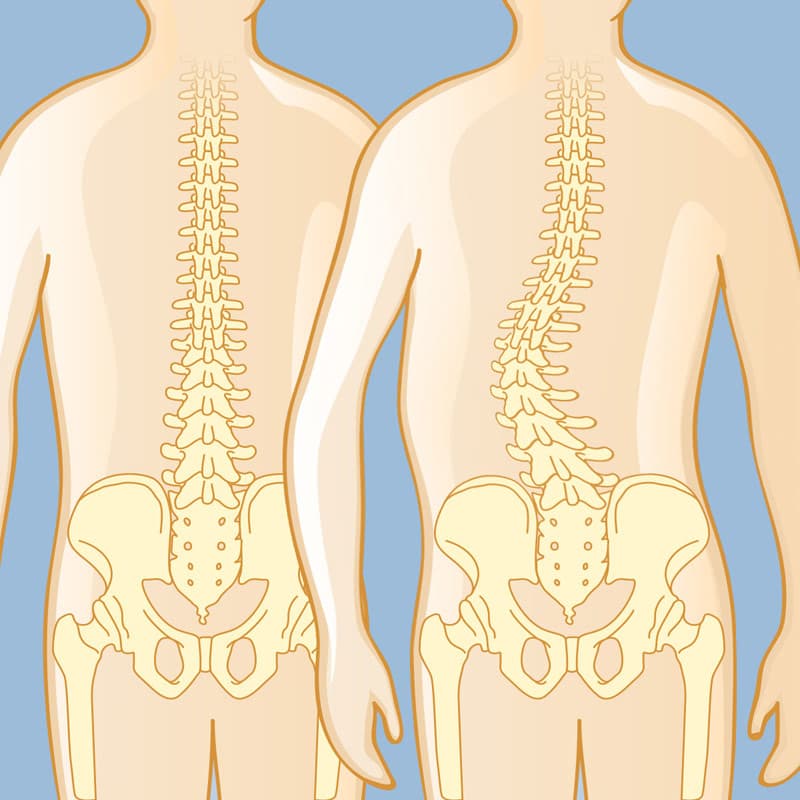 Spinal Deformity medical condition