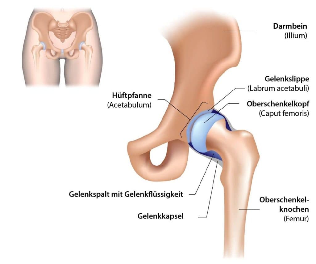 Coxarthrosis (Osteoarthrosis of the hip) medical condition