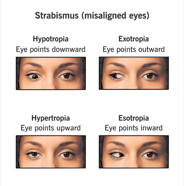 Strabismus medical condition