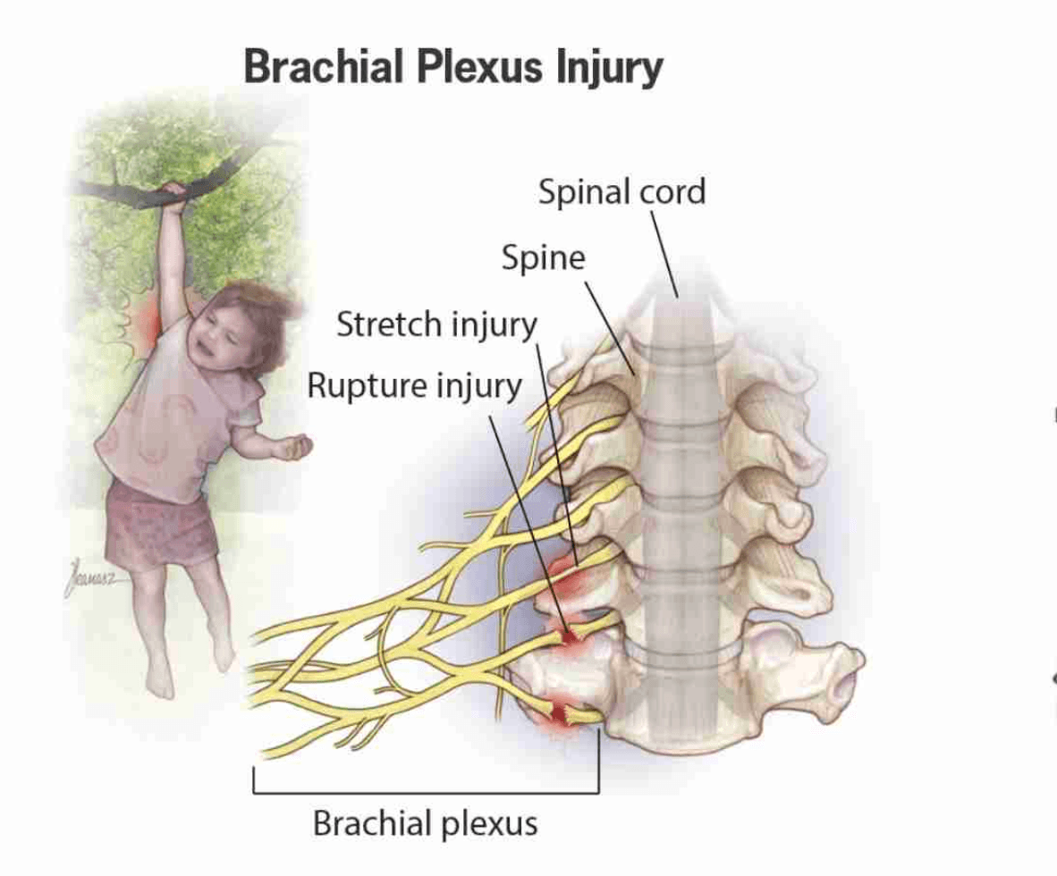 Brachial Plexus Palsy medical condition