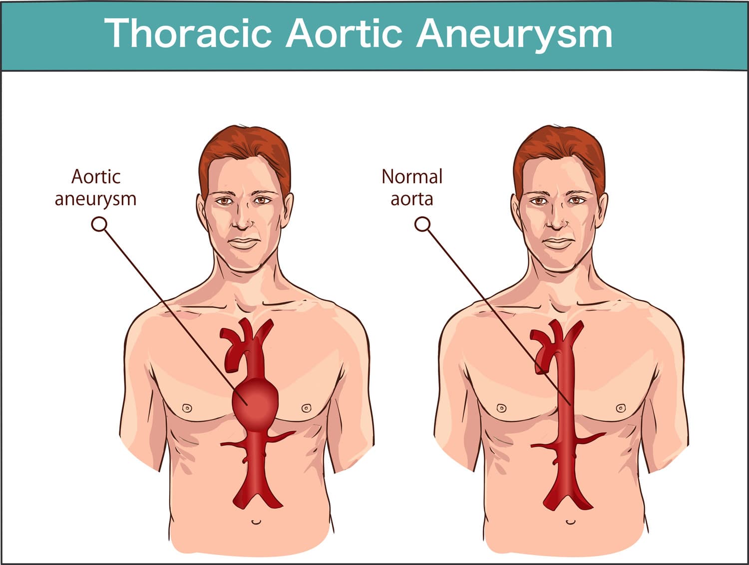Thoracic Aortic Aneurysm medical condition