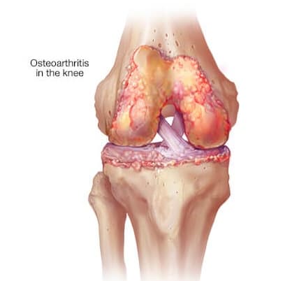 Knee Arthritis medical condition