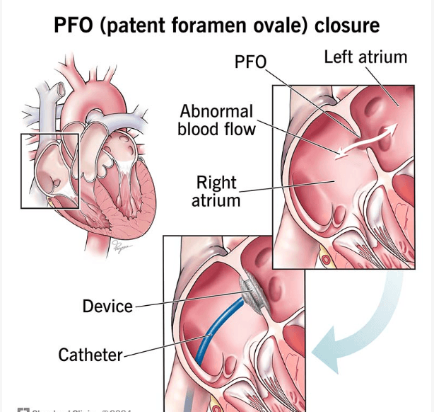 Closure of patent foramen ovale medical condition