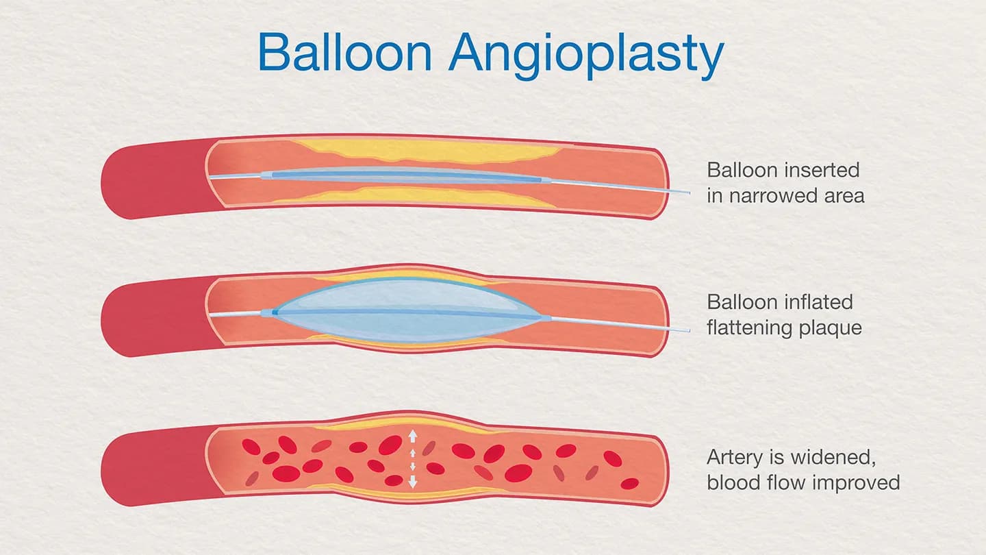 Balloon Angioplasty medical condition