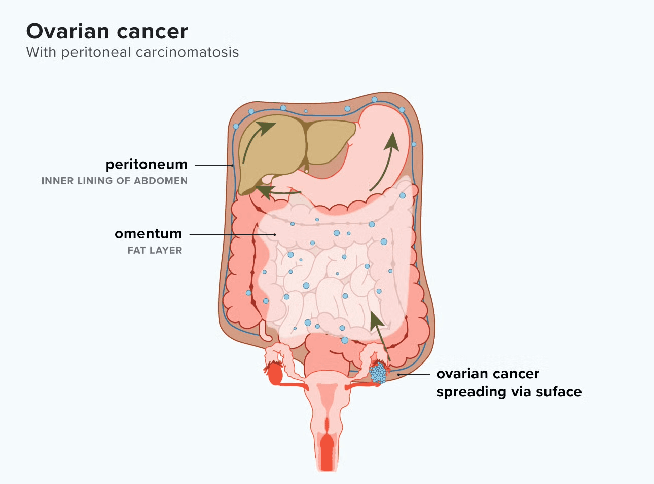 Peritoneal Carcinomatosis medical condition