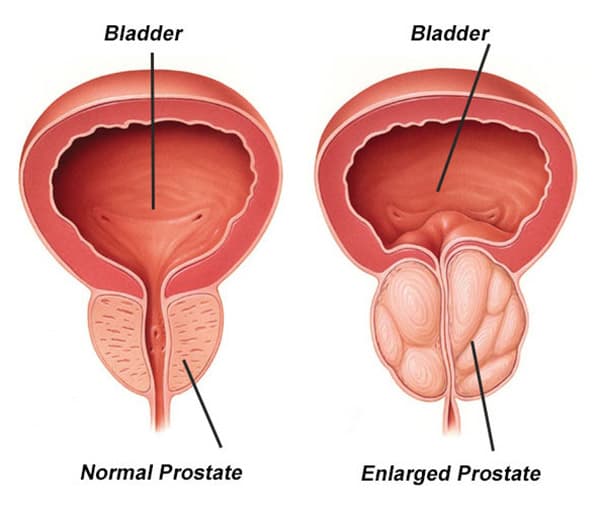 Benign prostatic hyperplasia medical condition
