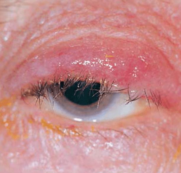 Blepharitis medical condition