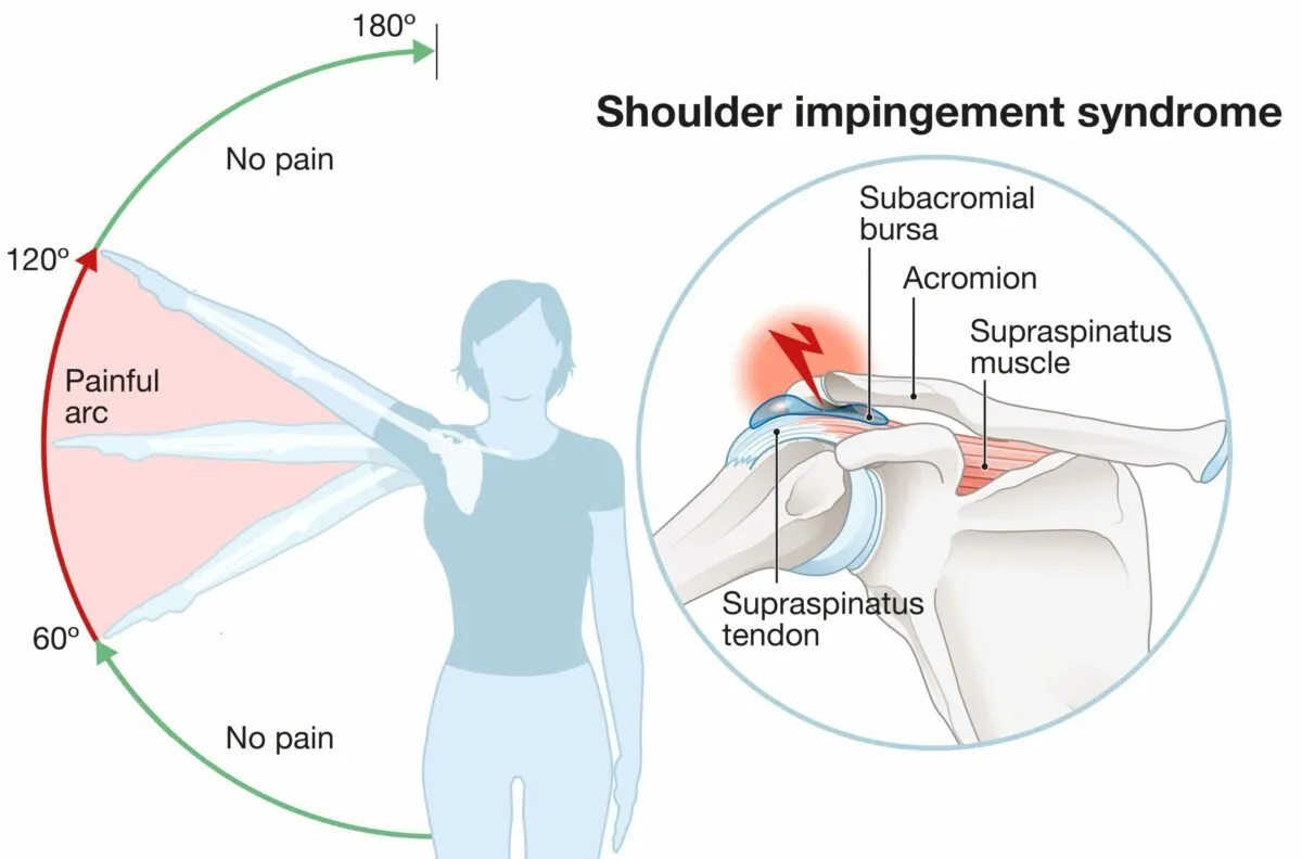 Shoulder Impingement medical condition