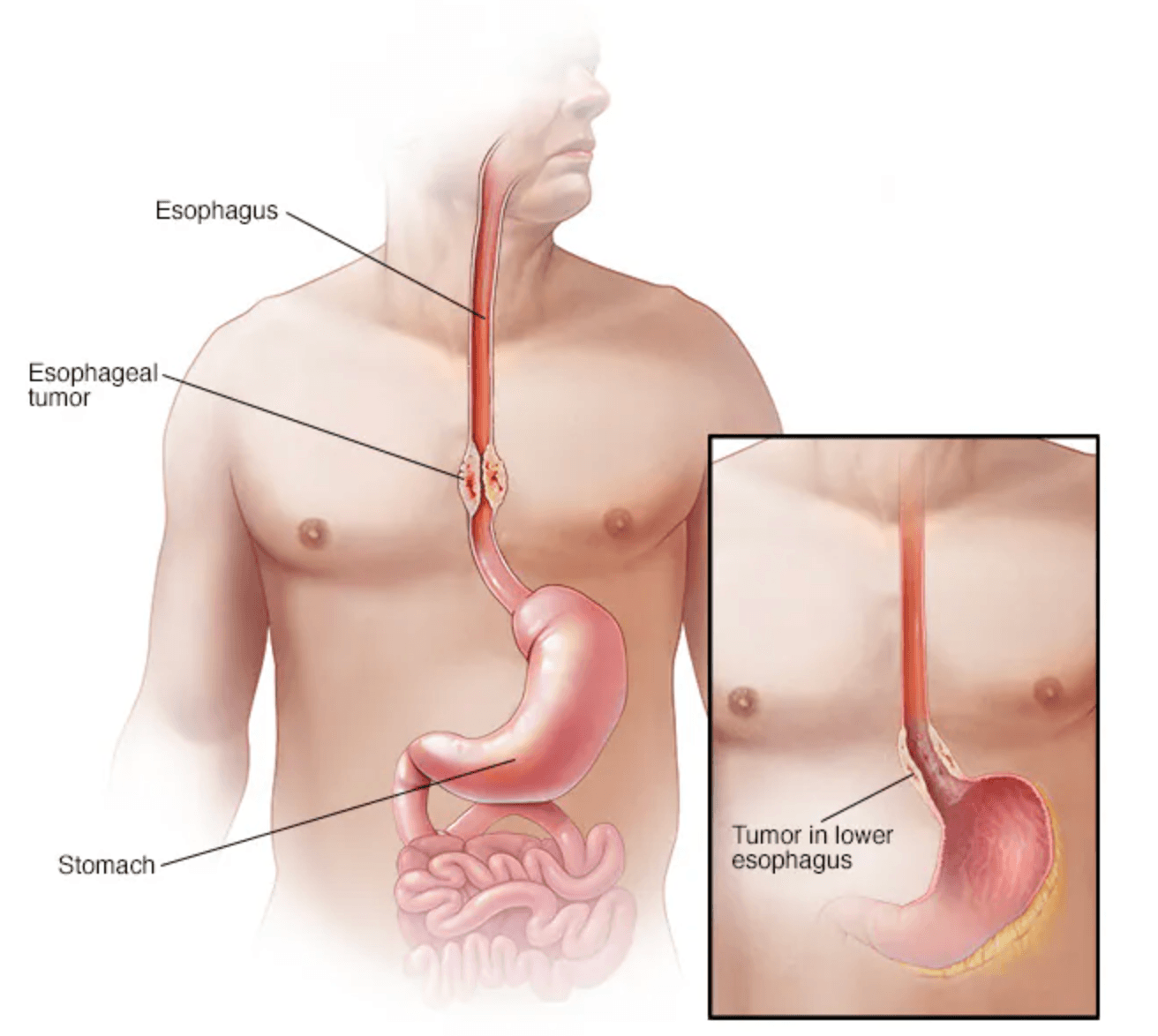 Esophageal Cancer medical condition
