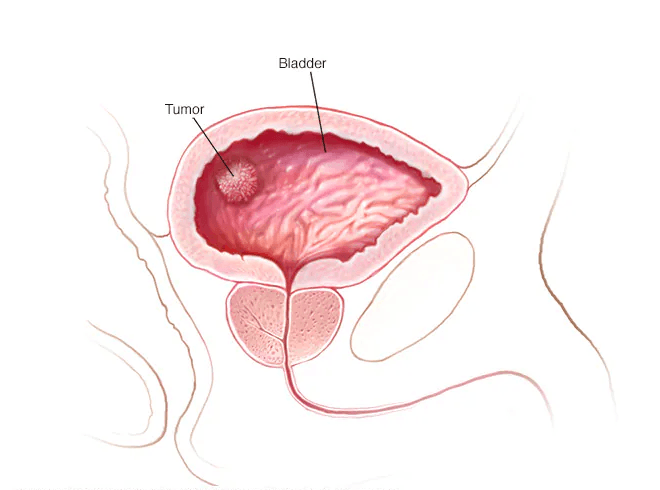 Bladder Cancer medical condition
