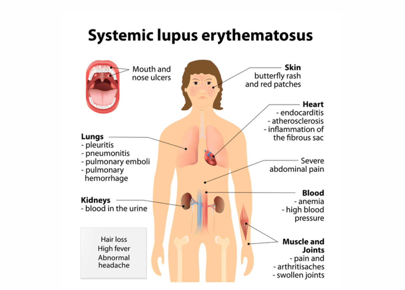 Systemic lupus erythematosus medical condition