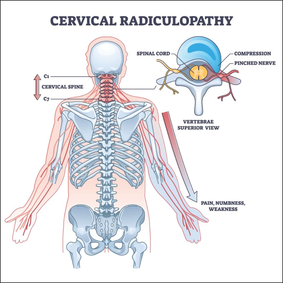 Cervical Radiculopathy medical condition