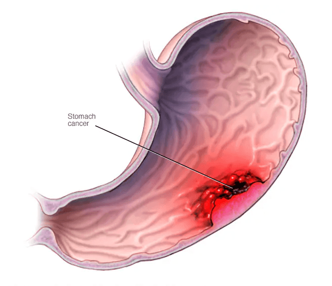 Stomach Cancer medical condition