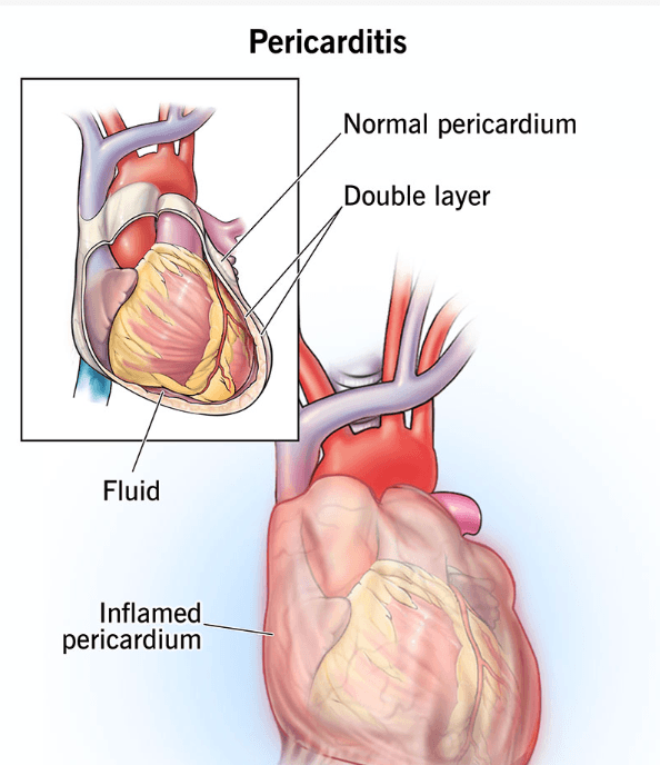 Pericarditis medical condition