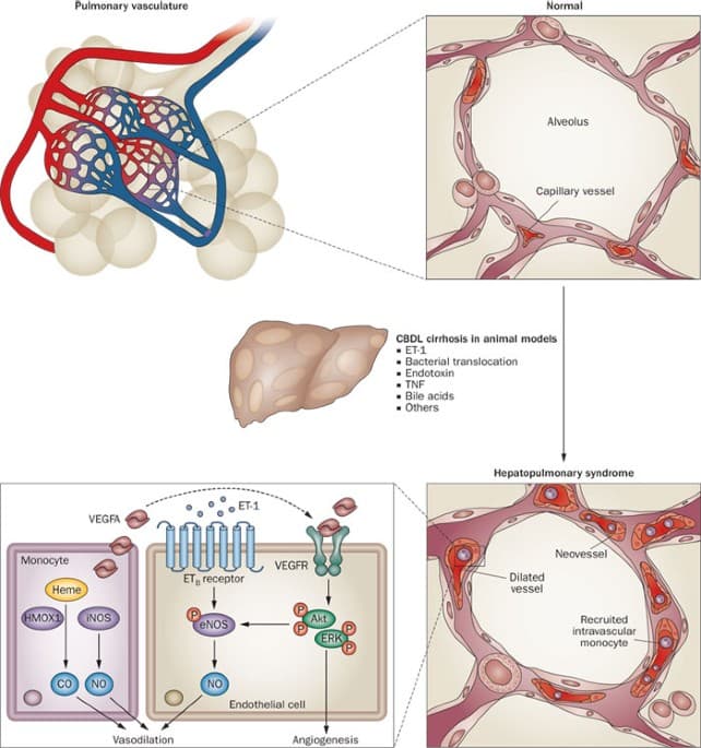 Hepatopulmonary Syndrome (HPS) medical condition