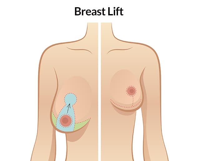 Breast lift medical condition