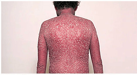 Psoriasis medical condition