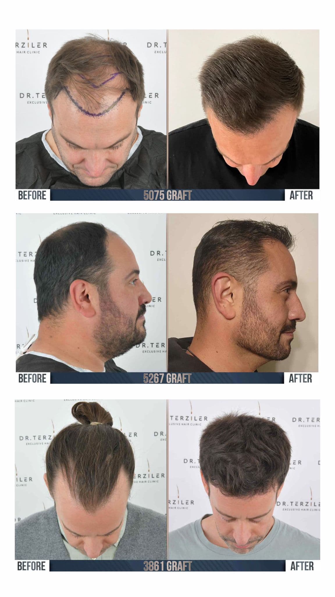 Hair transplantation medical condition